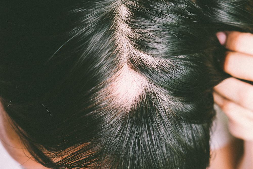 How to Treat Alopecia