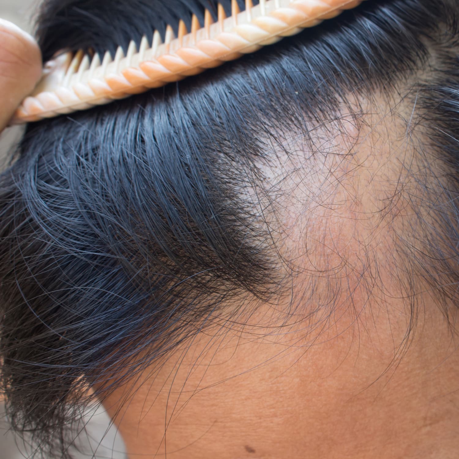 How to Treat Alopecia