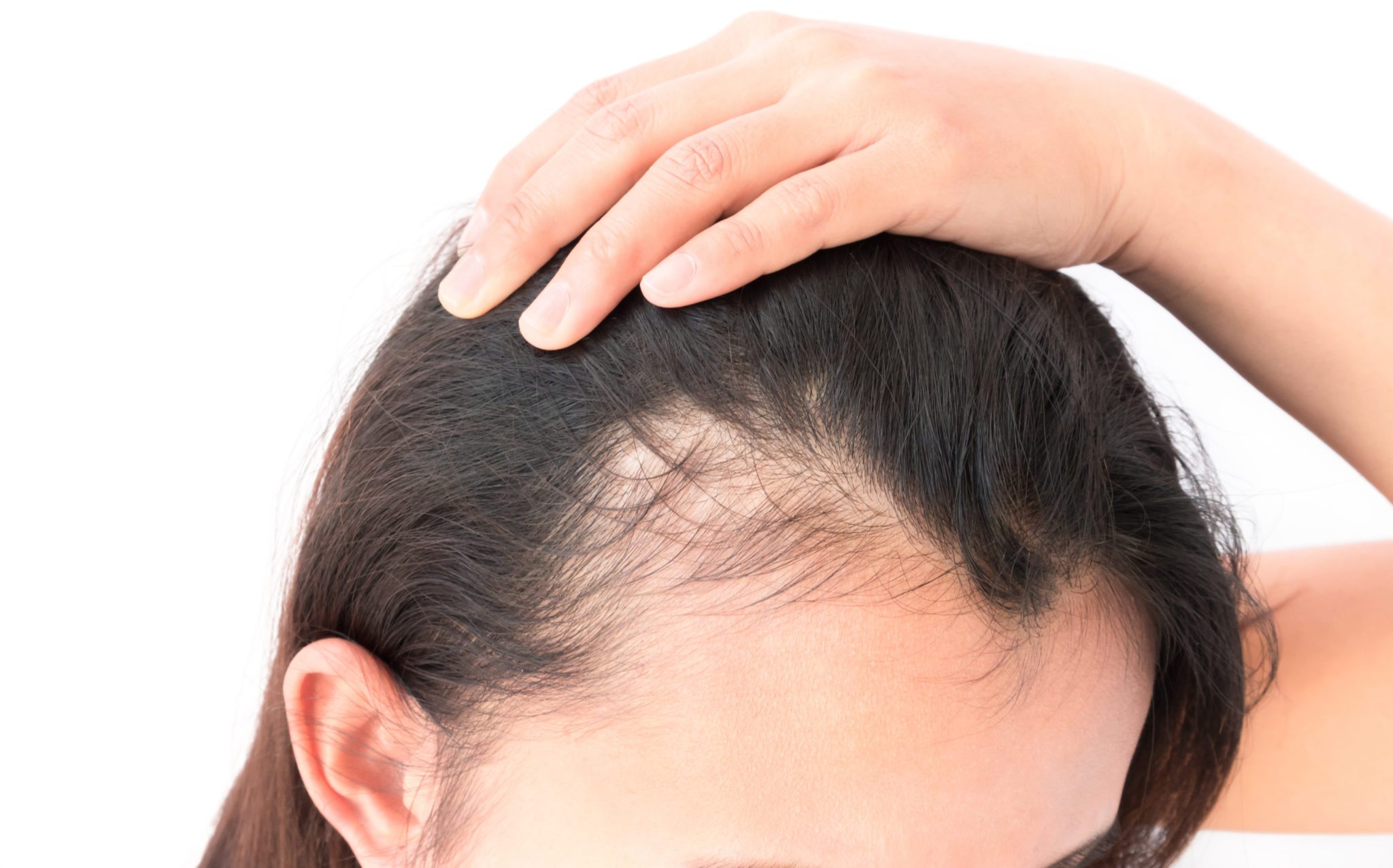 Female Alopecia Treatment