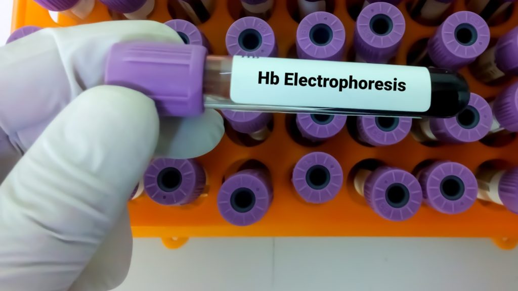 Hemoglobin Electrophoresis Test